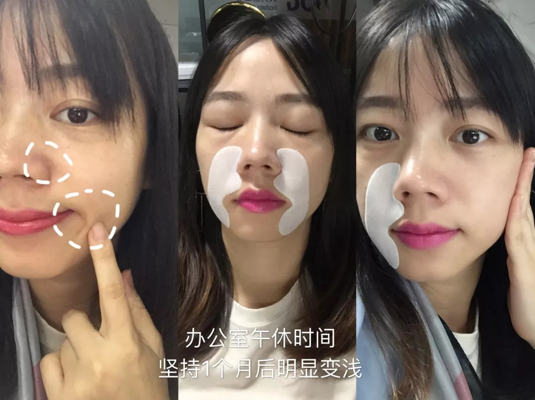 微晶法令纹贴抗皱纹提拉紧致面膜,淡纹抗皱法令纹面膜推荐