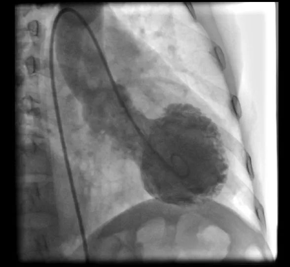 吵架后胸痛呼吸不畅,吵架后胸突然疼痛怎么回事