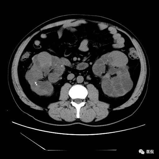 肾功能不全双肾回声稍增强怎么办,肾ct检查双肾萎缩