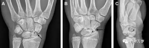 肩关节脱位易漏诊的骨折,放射科容易漏诊的骨折