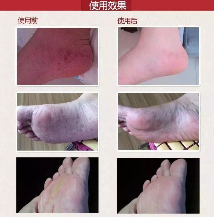 皮肤湿疹万能膏,泰国顽固性皮肤病排毒止痒膏