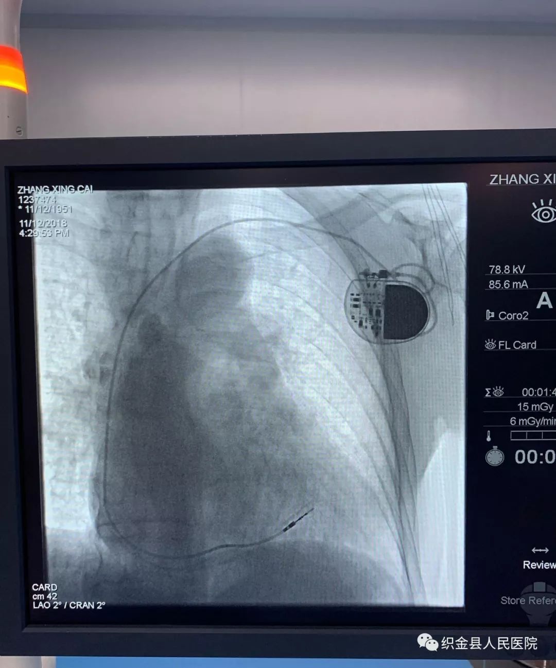 最新心脏起搏器植入示意图,心脏起搏器手术最好前十名医院