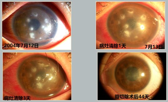孙旭光眼科医生,孙旭光大夫角膜塑形镜危害