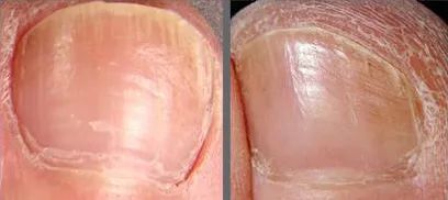 十年灰指甲可以治好吗,一次搞定顽固灰指甲
