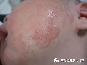 「杏林微科普」湿疹,我该拿你怎么办?——防护治疗篇