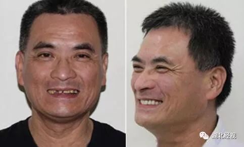 全城征集免费种植牙,全城征集免费种牙