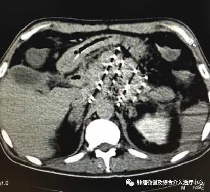 胰腺癌碘125粒子治疗术几天出院,胰腺癌晚期适合碘125粒子植入吗