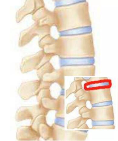 打个喷嚏闪了腰要去医院吗,一个喷嚏闪了腰
