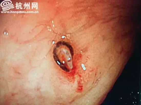 女子反复便血竟查出肠癌,女子便血做肠镜