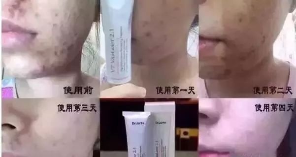 一支“激光霜”帮你解决众多困扰~