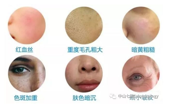 中山一院光子嫩肤,中山七院点阵激光