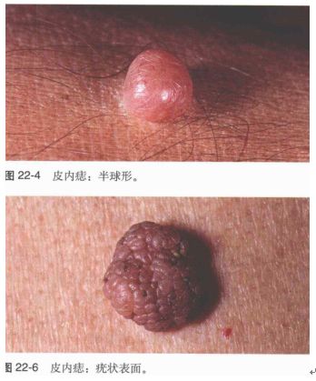 你说不“痣”道的事！