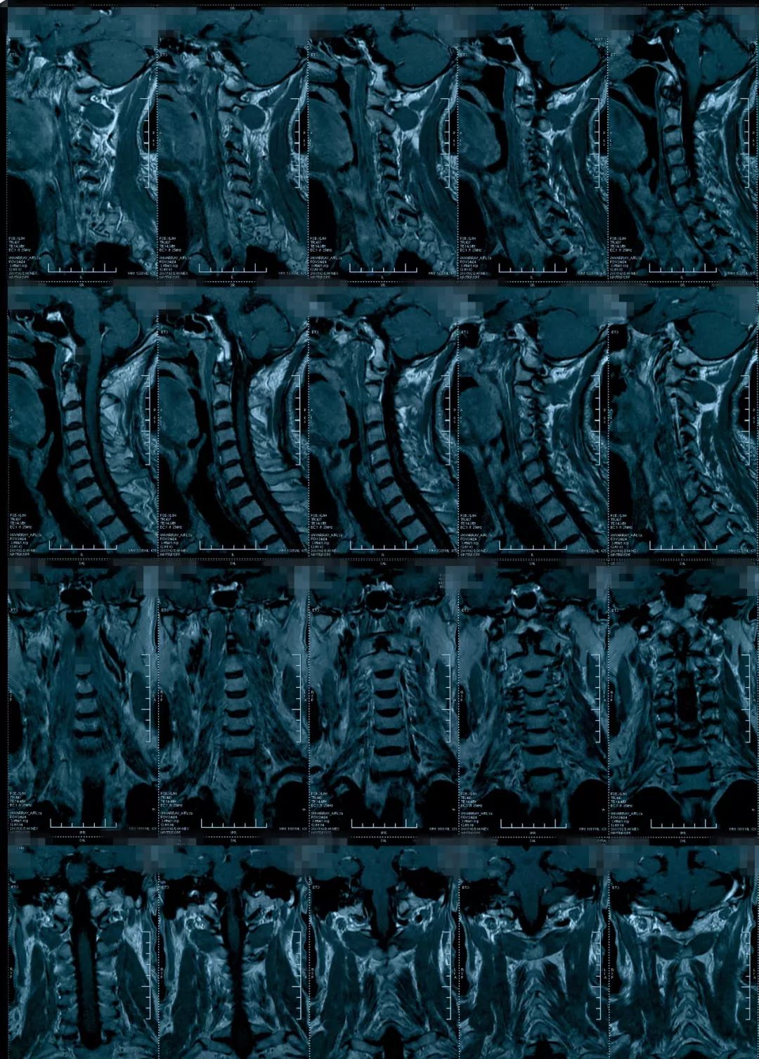 椎管狭窄水肿最佳治疗方法,椎管水肿如何治疗