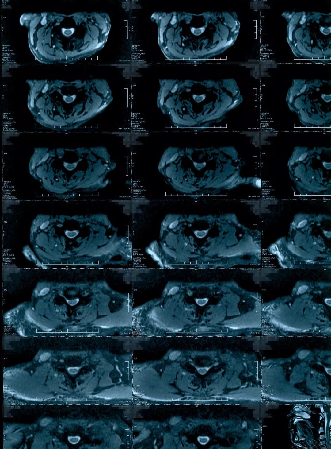 椎管狭窄水肿最佳治疗方法,椎管水肿如何治疗