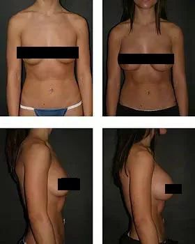 隆胸风险大还是缩胸大,胸大重要还是瘦重要