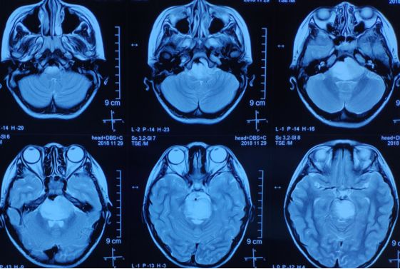 赞！重庆三博江陵医院成功开展脑干占位立体定向活检术！