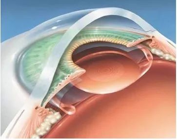 共享大医生｜得了白内障，怎么办？
