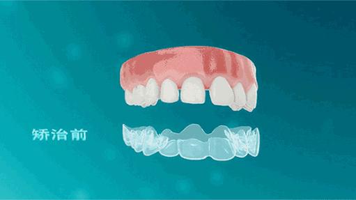 武汉种植牙齿多少钱一个,湖北种植牙补贴政策是真的吗