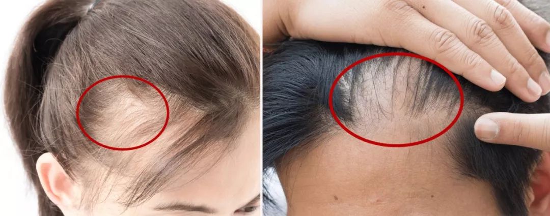 疯狂掉头发发际线后移,疯狂掉头发头发变得稀疏