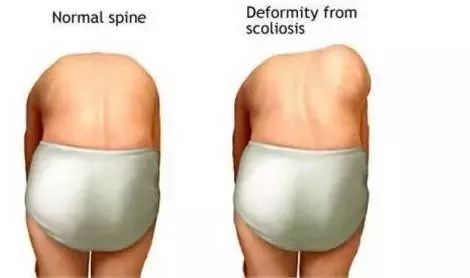 得了脊柱侧弯？你应该这样解决