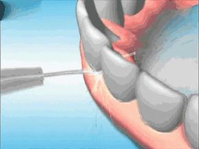 推广|身份证42开头的注意!牙齿矫正、种植牙,这些全免费!