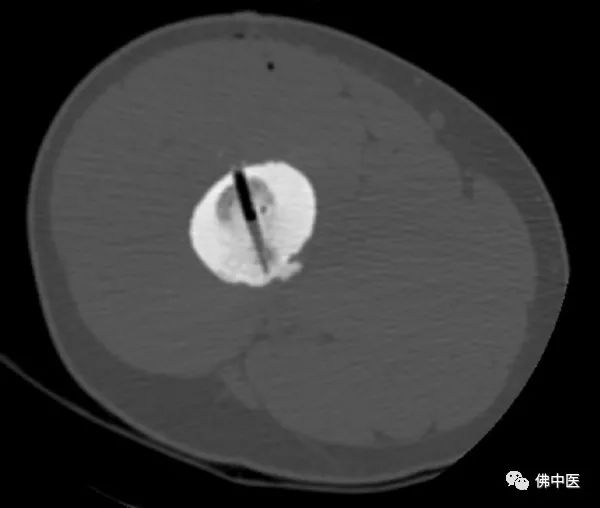 「安心过年」微创手术直击病灶！两骨瘤患者慕名而来，携健康回家