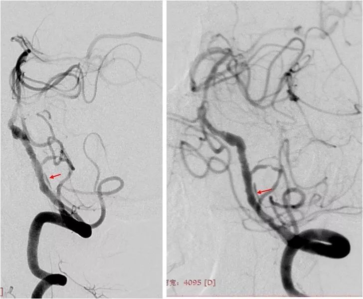 椎动脉v4段血管瘤介入治疗,臭氧治疗左侧v4段椎动脉狭窄