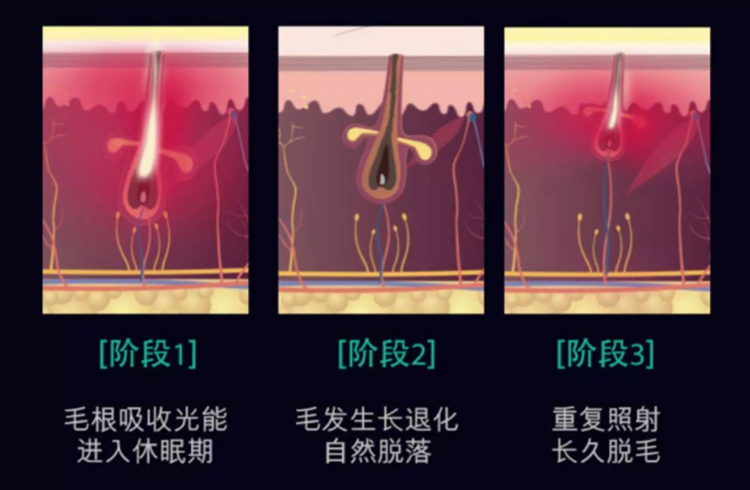 有什么方法可以脱毛永不生长,脱毛不再长的方法