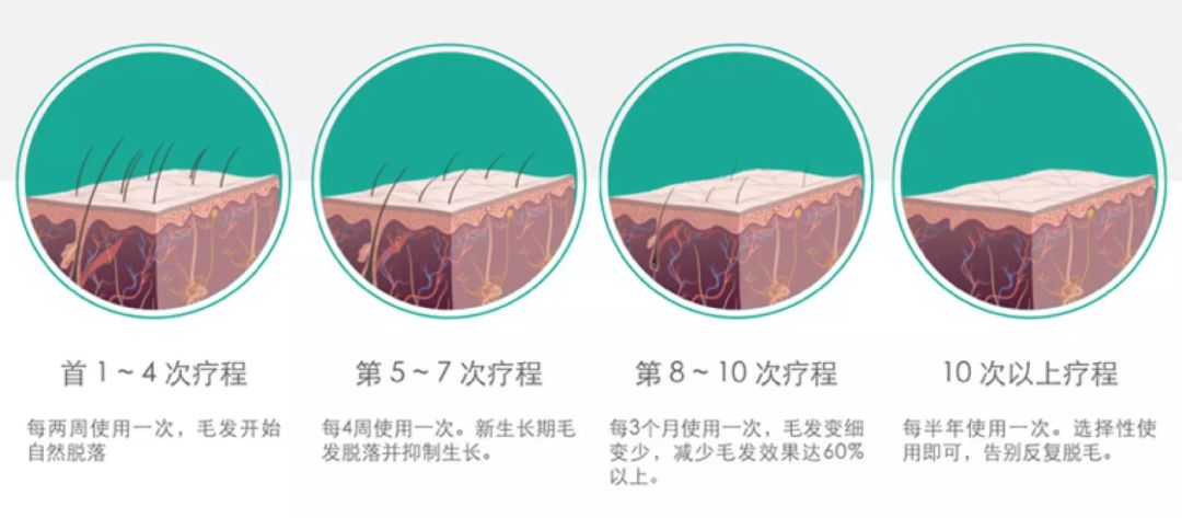 有什么方法可以脱毛永不生长,脱毛不再长的方法