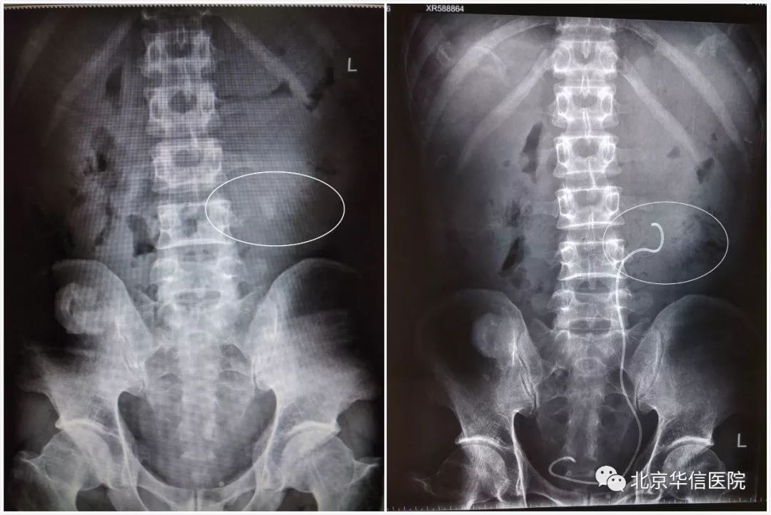 小通道解决大问题——清华大学第一附属医院“水利工程师”为患者解除病痛
