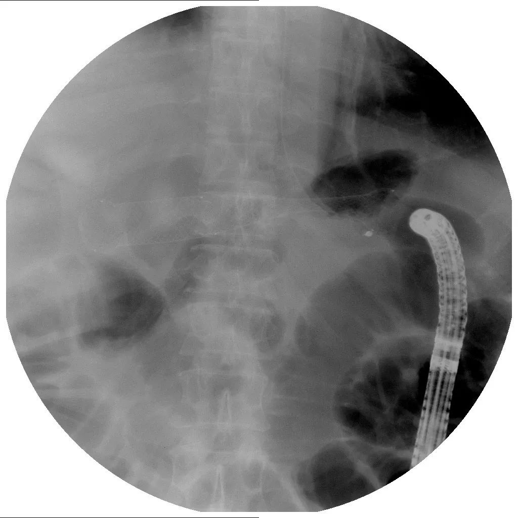 消化道支架置入术,消化道梗阻支架怎么放
