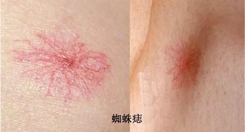 这种痣可能是肝癌信号,肝癌胸前小红痣样子