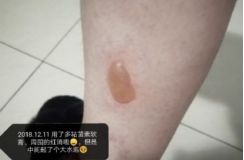 热水袋烧伤,热水袋烧伤起泡怎么处理