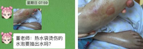 热水袋烧伤,热水袋烧伤起泡怎么处理