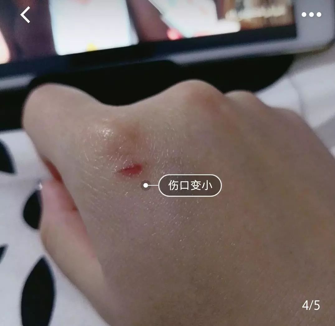 疤痕体质如何去痘印和烫伤印,烫伤色素疤痕修复的最新方法