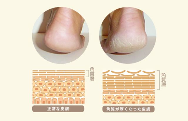 干裂的脚后跟图,干裂的脚后跟