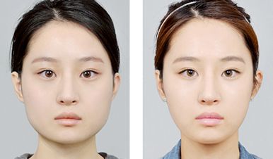 外用涂抹式肉毒素可以祛皱纹吗,去皱纹的肉毒素一年打几次为佳