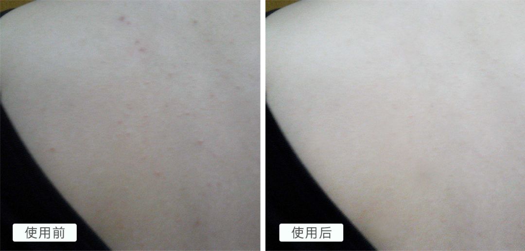 教你1分钟清除99%的脸上螨虫,10秒祛螨虫的药膏