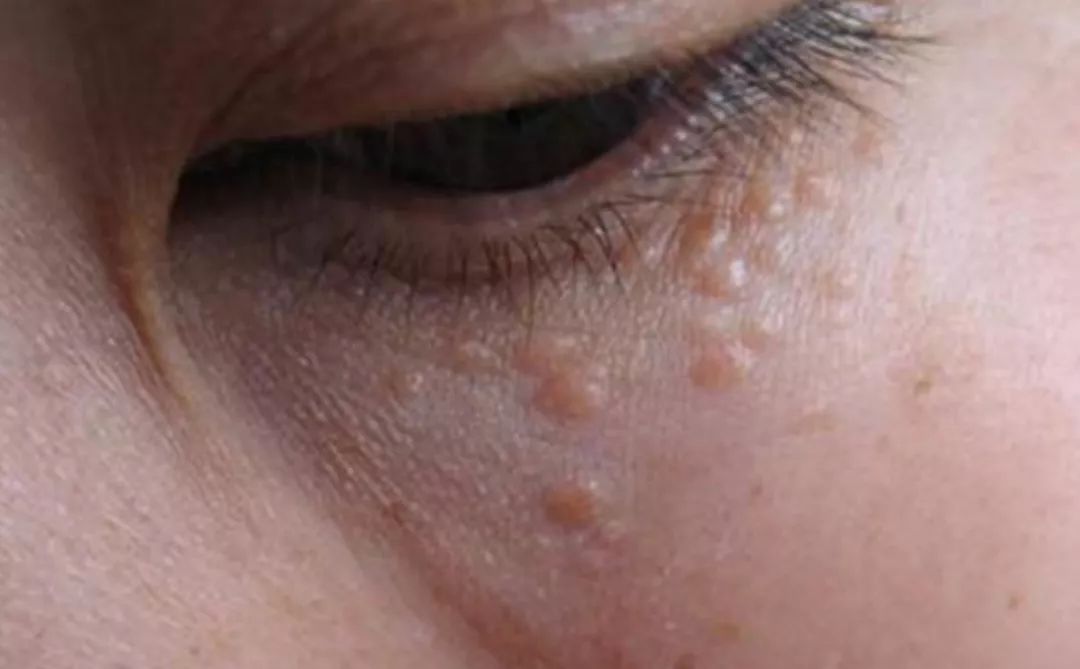 涂眼霜会引起汗管瘤吗,涂眼霜会引起眼部斑吗