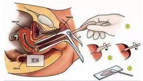 姐妹们输卵管造影检查,妇科检查能查出来有没有做过吗