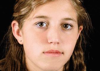 严重痘印晒斑,5个祛斑小妙招淡化晒斑雀斑痘印