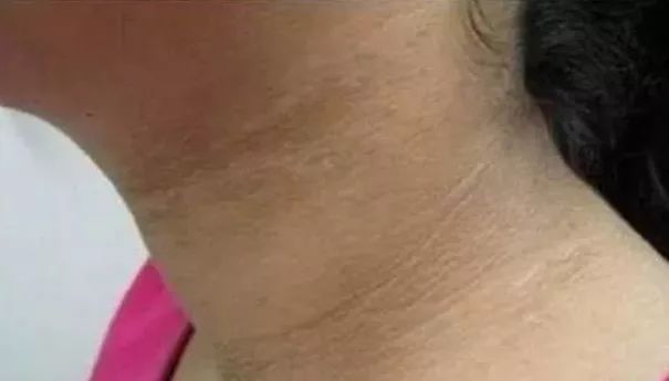 孩子脖子很黑洗不掉是怎么回事,孩子脖子黑洗不下去