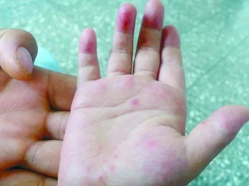 宝宝得了湿疹皮炎怎么办,婴儿特殊类型的湿疹以及皮炎