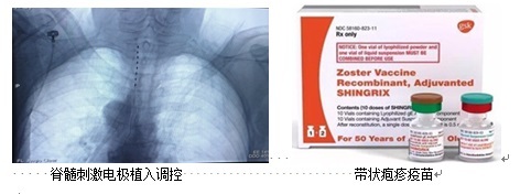 蛇盘疮带状疱疹可以吃病毒灵吗 (蛇缠头带状疱疹)