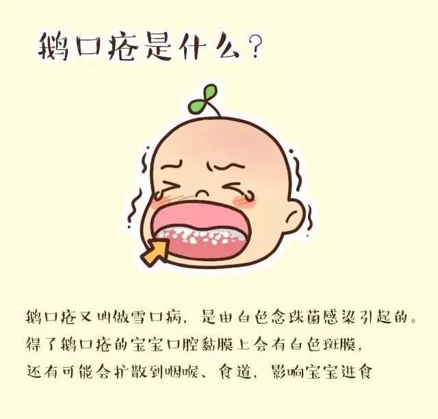 青岛妇幼治疗鹅口疮的药,妇幼治疗鹅口疮的药