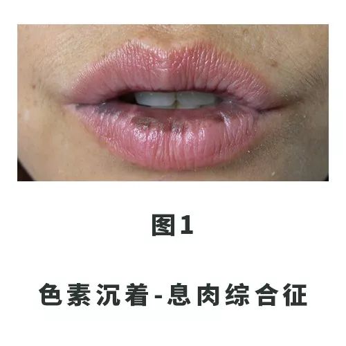 口唇有黑斑怎么消除,口唇上有黑斑是怎么回事