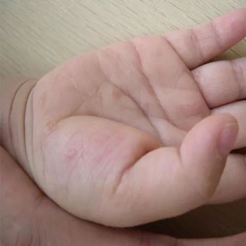 痒痒痒！疥螨会在皮肤内挖掘隧道