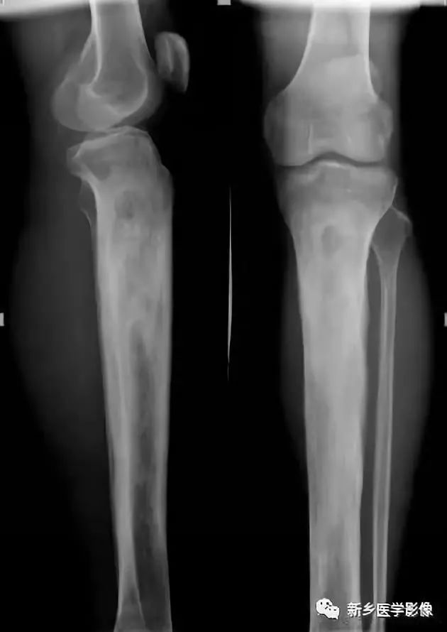 骨骼疾病怎么调理最有效,骨骼坏死最佳治疗方法