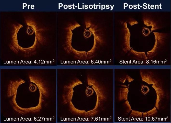 CIT2019｜李妍教授：OCT指导钙化病变，这些精髓要知道