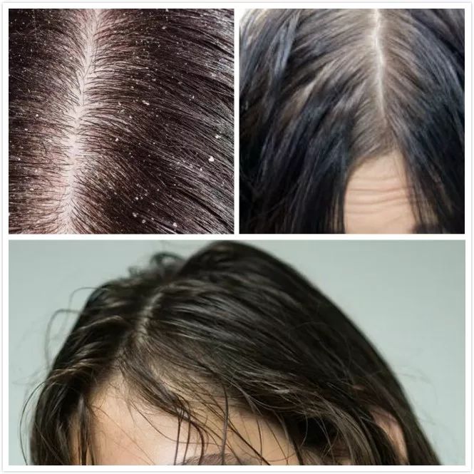 生发长头发神器,脱发生发最新科技